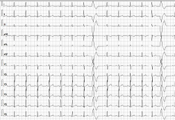 tracé d'electrocardiogramme