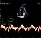 image d'échographie cardiaque flux sanguin