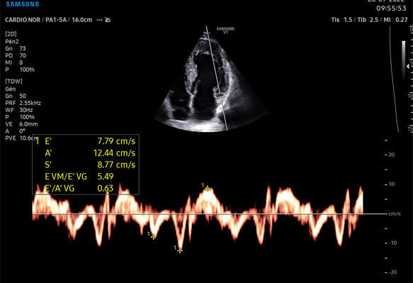 image d'échographie cardiaque flux sanguin